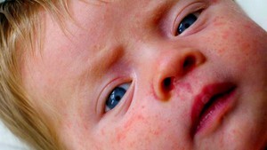 Аллергия на сахар у ребенка