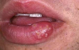 Отек губы аллергия