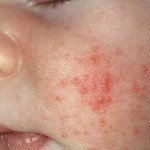 Чем помазать аллергию на лице у грудничка