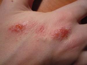 Средство от аллергии на руках