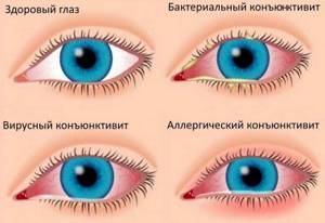 Зуд глаз при аллергии