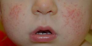 Аллергический дерматит симптомы и лечение у детей