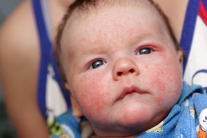 Чем лечить аллергию у младенца