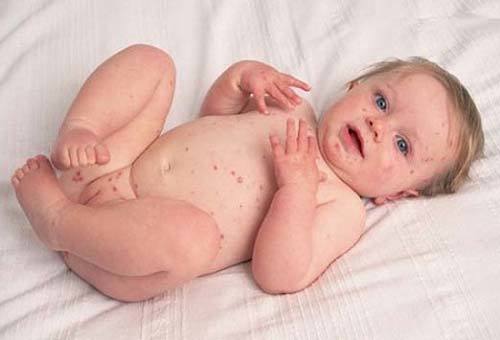 Аллергия на череду у новорожденного