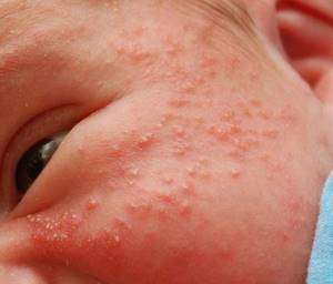Потница или аллергия у новорожденных как отличить