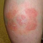 Аллергия на лейкопластырь волдыри