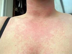 Как может выглядеть аллергия