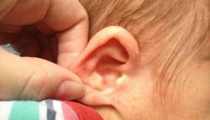 Аллергия на ушах у взрослого