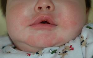 Аллергия на молочную кашу у грудничка