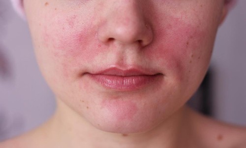 Мазь от аллергии для лица