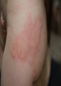 Аллергия в виде волдырей у ребенка