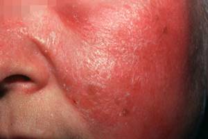 Аллергия на крем для лица что делать