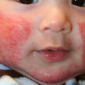 Аллергия на ушастый нянь