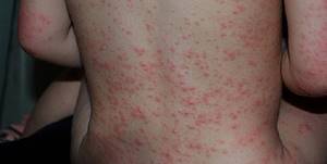 Аллергия на антибиотики сыпь