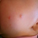 Аллергия у ребенка на комариные укусы