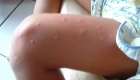 Аллергия на коже как укусы комаров
