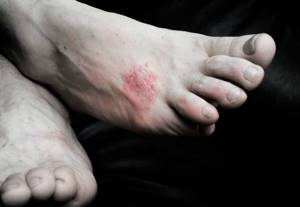 Аллергия на ногах