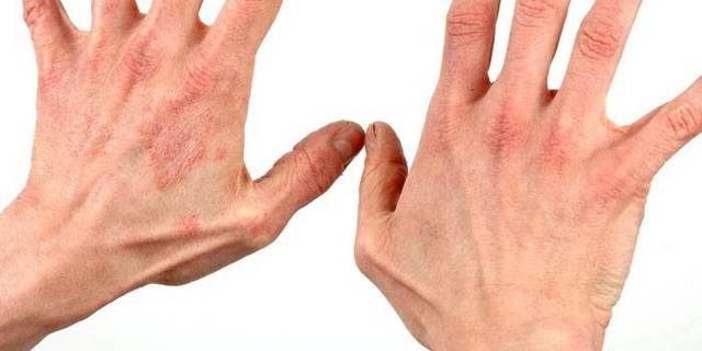 Экзематозный дерматит на руках