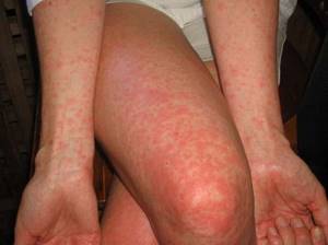 Аллергия в виде бляшек