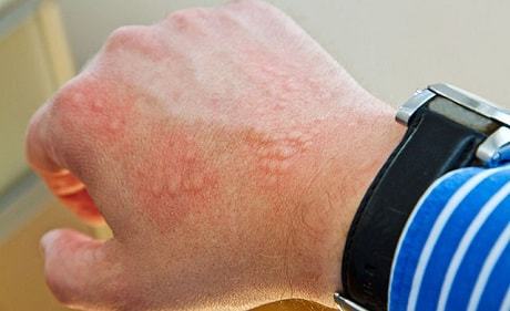 Чем лечить аллергию на коже взрослого
