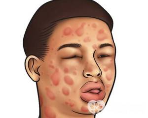 Холодовая аллергия лечение