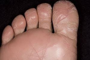 Контактный дерматит на ногах