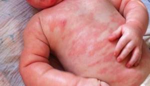 Сыпь на антибиотики у ребенка