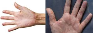Аллергия на гель для наращивания ногтей
