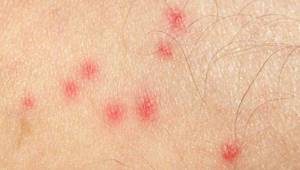 Аллергия как укус комара