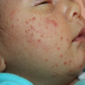 Крем от аллергии для новорожденных