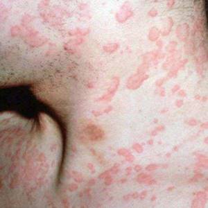 Аллергия заразна