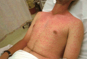 Аллергия на антибиотики сыпь