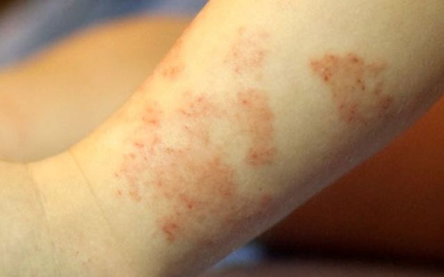 Аллергия на порошок у детей