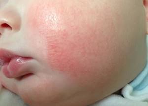 Бепантен при аллергии у новорожденных