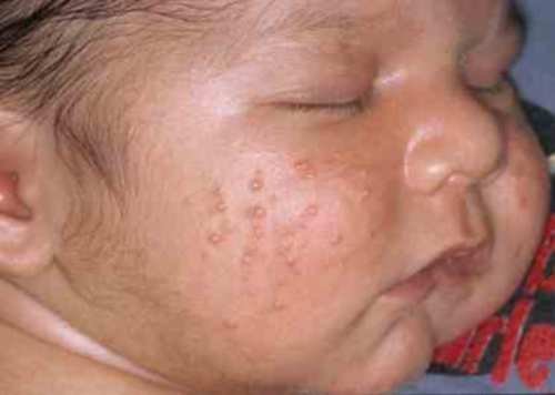 Аллергия у маленьких детей