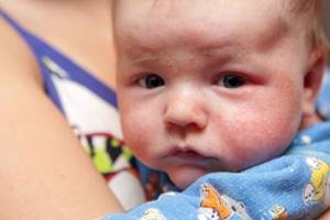 Аллергия у ребенка на щечках