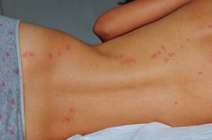 Аллергия на коже сыпь