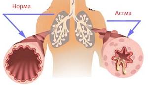 Чем лечить бронхиальную астму у взрослых
