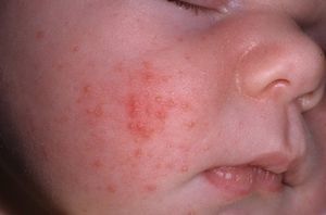 Аллергия на тыкву у ребенка