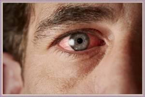 Аллергия на веках глаз лечение