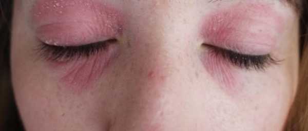 Аллергия на тушь