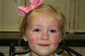 Пробы на аллергены у детей
