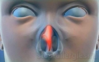Чихание и заложенность носа