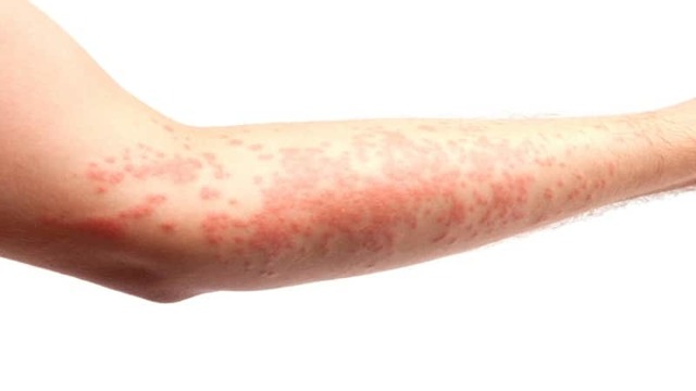 Мази при аллергии на коже у взрослых