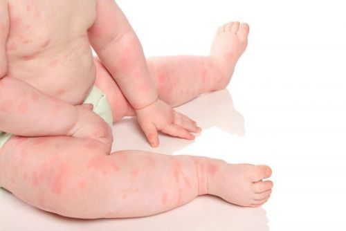 Аллергия у младенца на смесь