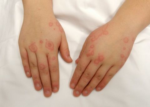 Аллергия на латексные перчатки