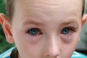 Глазные капли от аллергии детям