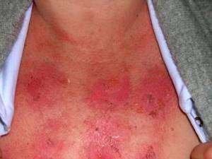 Аллергия на лейкопластырь