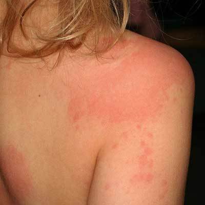 Аллергия на порошок как проявляется