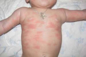 Аллергия на молочные продукты у ребенка